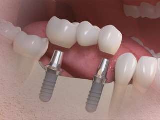 Most na implantach zębowych