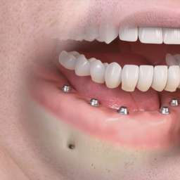 Most na 6 implantach zębowych