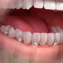 Most na 6 implantach zębowych widok końcowy